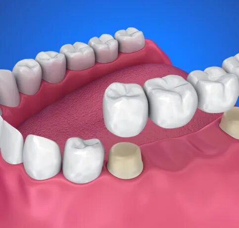 How to Maintain and Clean a Fixed Dental Bridge Correctly
