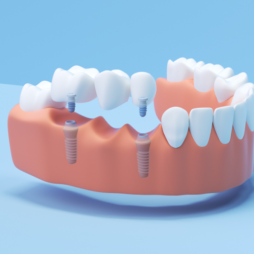 Are dentures implants removable?