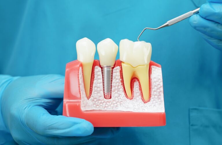 Are dentures implants removable?