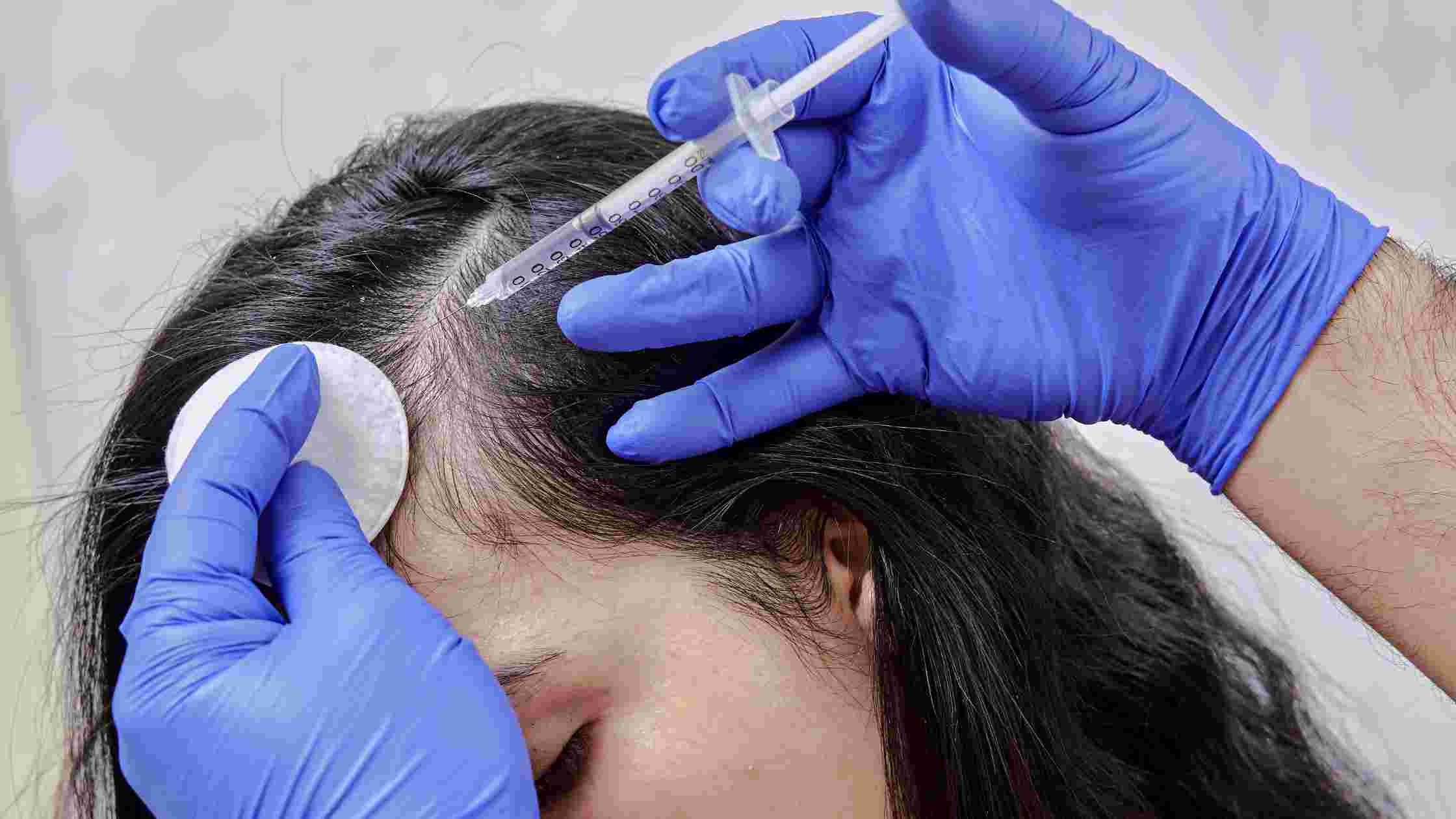 Can Hair Transplant for Women Delhi Combined with PRP Hair Treatment Delhi Improve Hair Density?