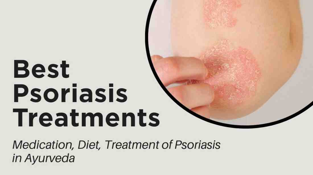 Why Is It Important to Treat Psoriasis in Bangalore?