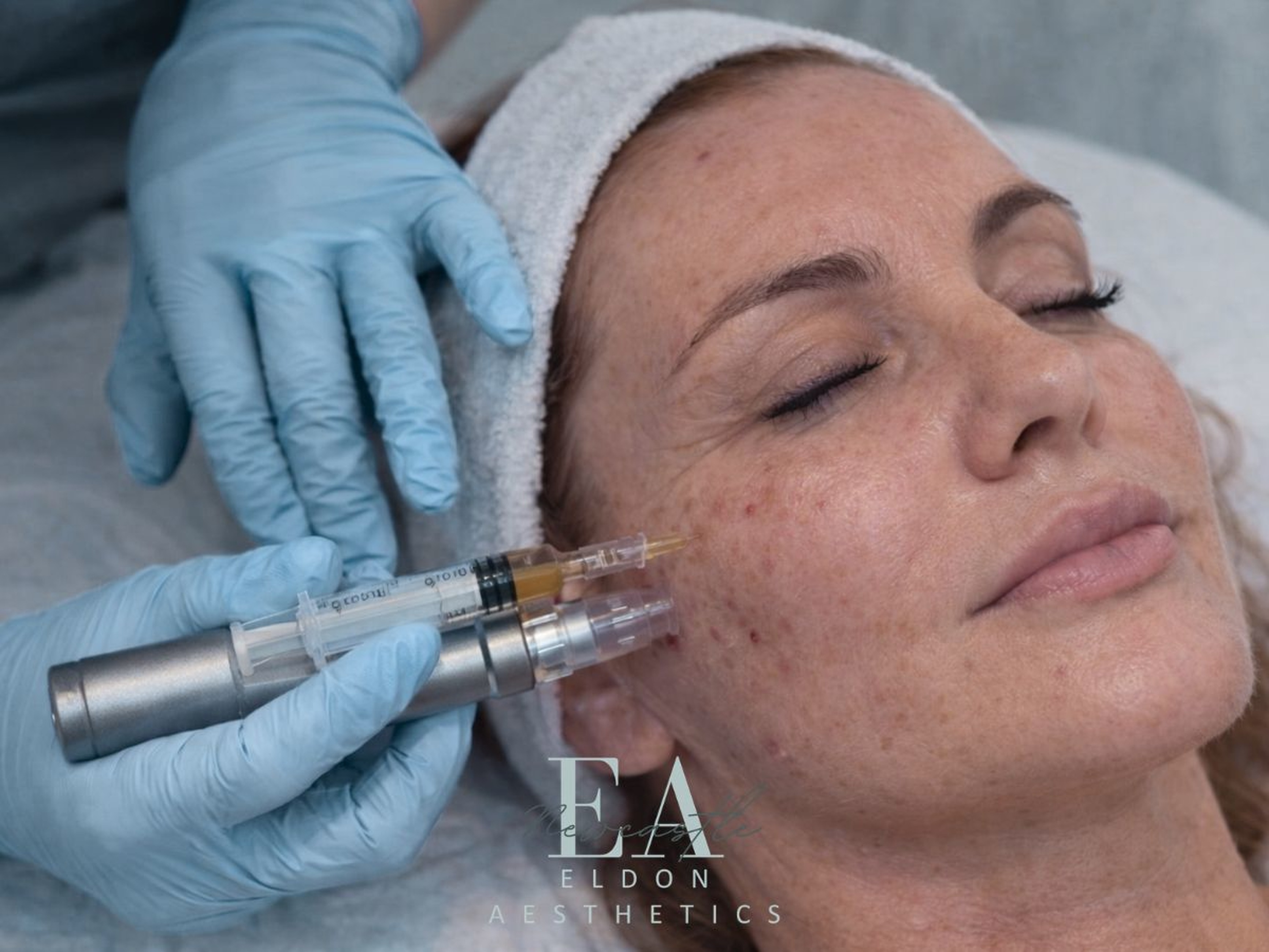 Mole Removal Newcastle | Safe & Effective Mole Removal in Newcastle