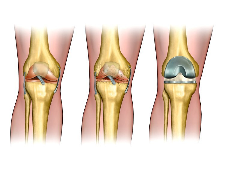 Understanding the Long-Term Benefits of Knee Replacement Surgery