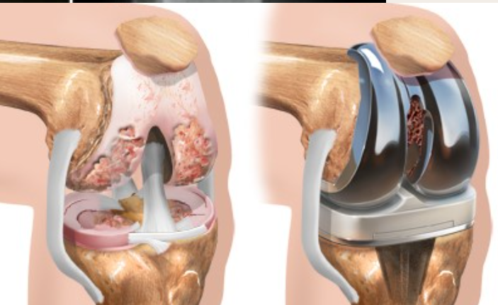 Understanding the Long-Term Benefits of Knee Replacement Surgery