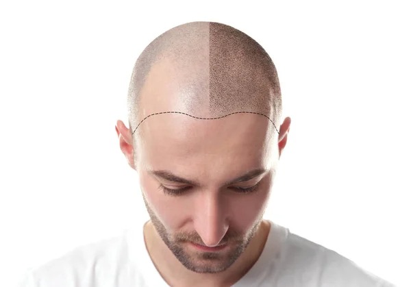 What Is the Success Rate of Hair Transplant?
