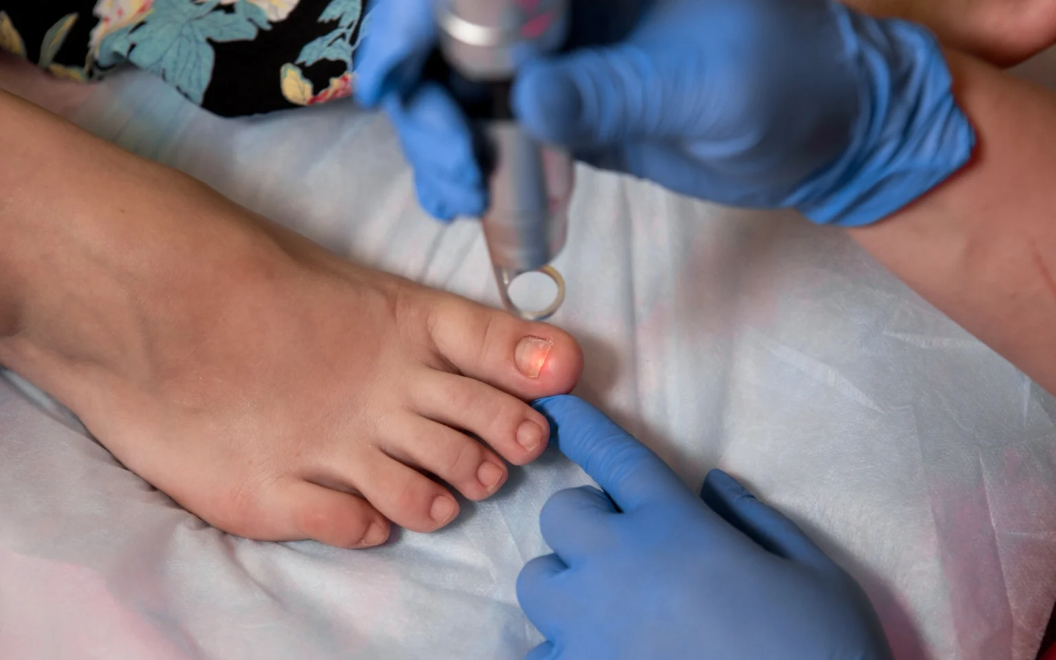 Toenail Fungus Treatment in Houston, TX – A Reliable Solution for Nail Fungus