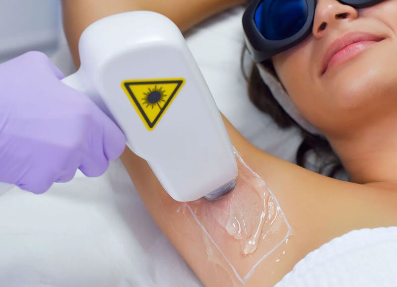 A Modern Approach to Unwanted Hair: Understanding Laser Hair Removal