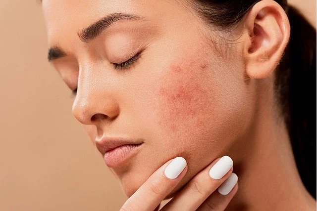 How to Choose the Best Dermatologist in Bandra for Effective Acne Treatment and Healthy Skin