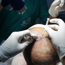 Ultra-Dense Hair Transplant in India ...