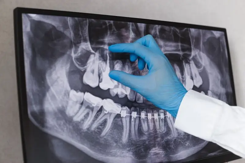 Tooth Infection Treatment: Signs, Solutions & How to Save Your Smile Before It’s Too Late