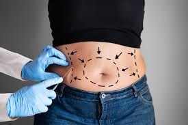 What is Liposuction, and Who Can ...