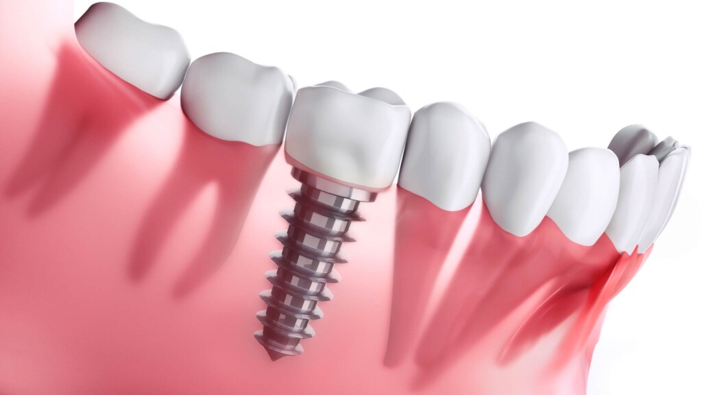 How do denture implants work?