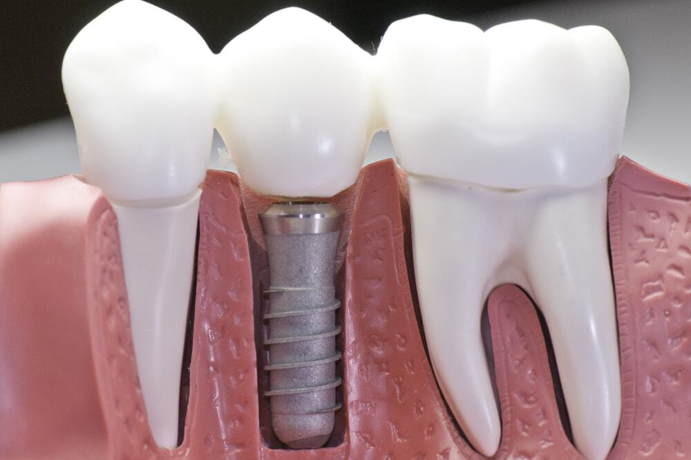 How do denture implants work?