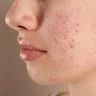 Treatment Acne