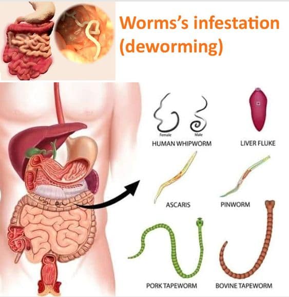 Pinworm Infection