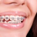Are retainers cheaper than braces-7adb8457