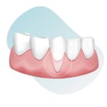 Can-receding-gums-grow-back-by-san-diego-periodontics-implant-dentistry-53838873