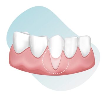 Can-receding-gums-grow-back-by-san-diego-periodontics-implant-dentistry-53838873