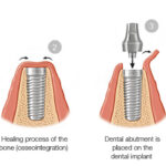 Dental-Implant-Procedure-Steps-42828ca3