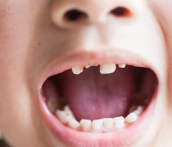 Do’s & Don’ts of Tooth Extraction for Kids-dd2673df