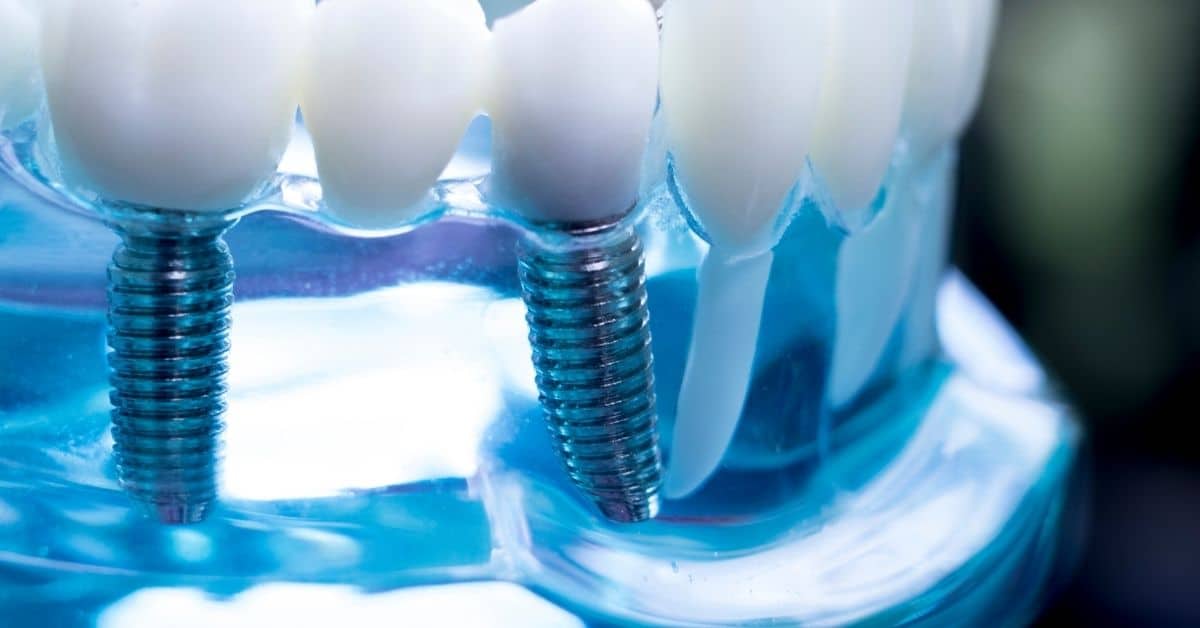 How long do dental implants last What impacts the duration-e7eb8d88