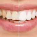 How long does sensitivity last after teeth whitening-4c8ac36e