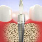 Where is the best place to get dental implants in India-6ba93114