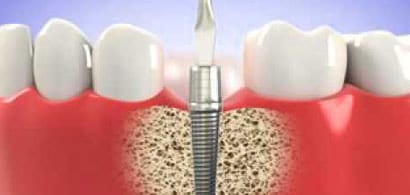 Where is the best place to get dental implants in India-6ba93114