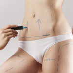 liposuction surgery in delhi