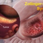 zollinger ellison syndrome-10a1bd3f