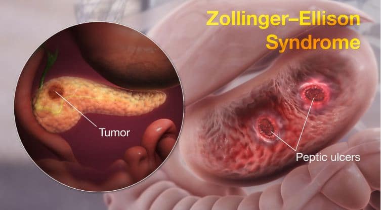 zollinger ellison syndrome-10a1bd3f