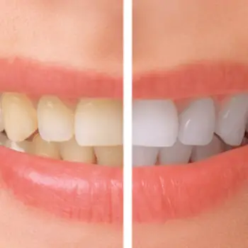 Teeth-Whitening-slider-1c9619a6