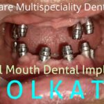 dental implant-54b16ef1