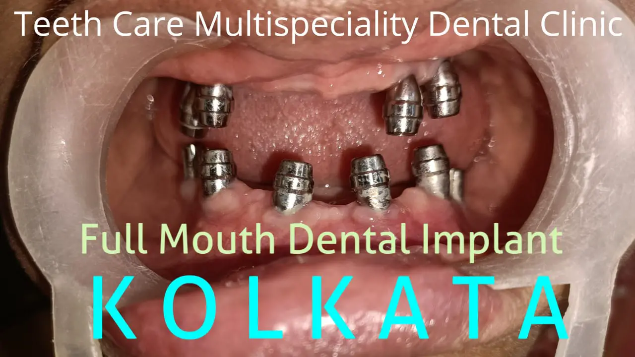 dental implant-54b16ef1