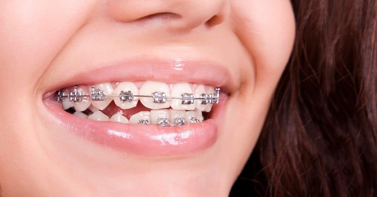 What are the things you should know about adult braces-8c766277