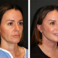 best-facelift-at-forty-before-after-90fa53bd