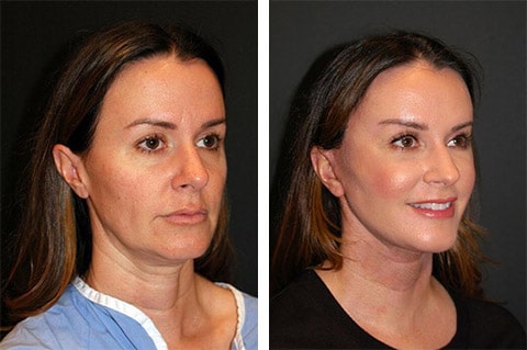 best-facelift-at-forty-before-after-90fa53bd