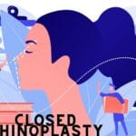 closed rhinoplasty-9a60d2d0