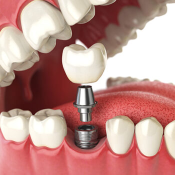 dental-iDental Implant Proceduremplants-anatomy-c91cfd26