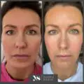 facial filler treatment doctor in Urmston-bc887bd2