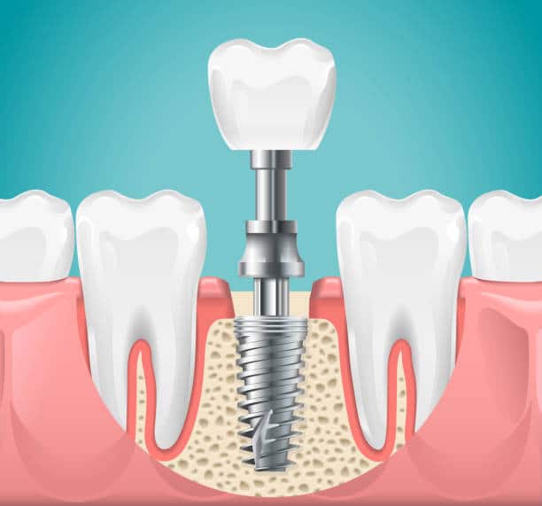 istockpdental Implants Benton arhoto-1173569283-612x612-ad5ff08b