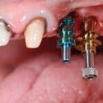 How many days does it take for Dental Implants-51a4e315