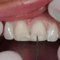 Procedure of Dental Veneers in Berwick-4a1e492a