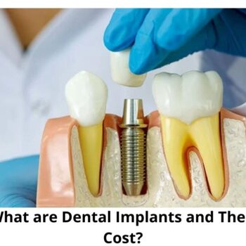 What are Dental Implants and Their Cost-4b21389f