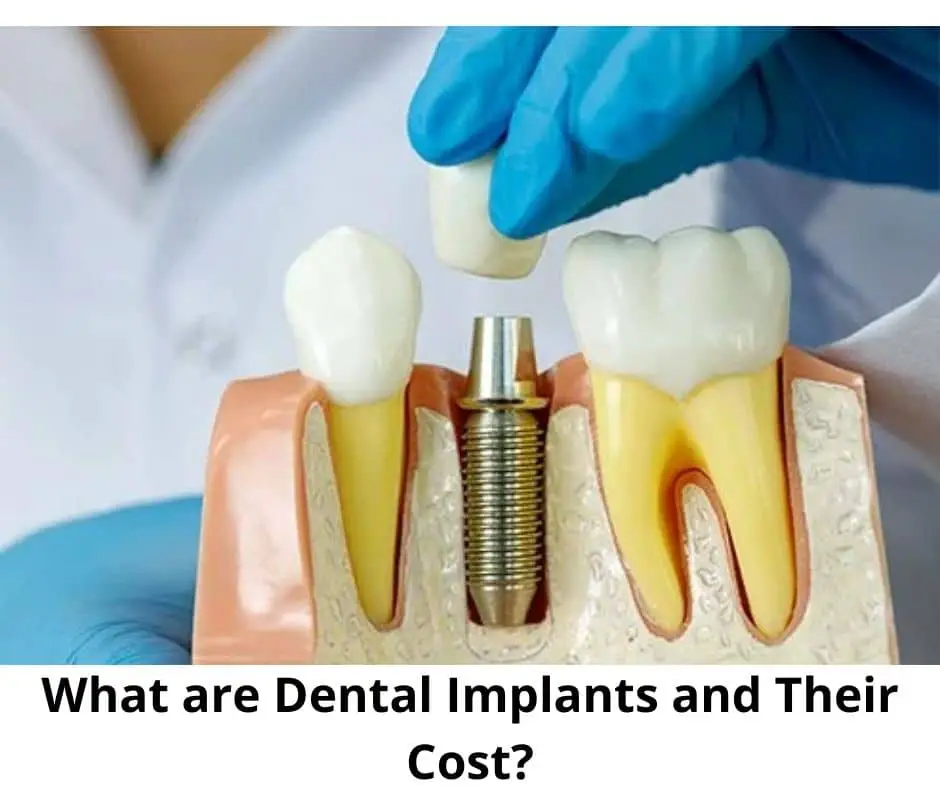 What are Dental Implants and Their Cost-4b21389f
