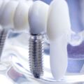What are some dental implant centers in India-6ae158ce