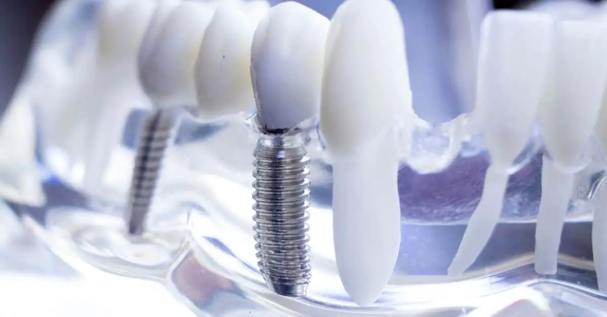 What are some dental implant centers in India-6ae158ce