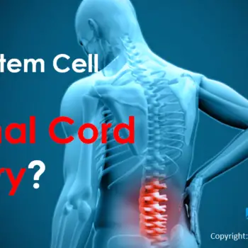 Zero Waiting Time Stem Cell Spinal Cord Injury Treatment in India attracts global patients-c65d4577