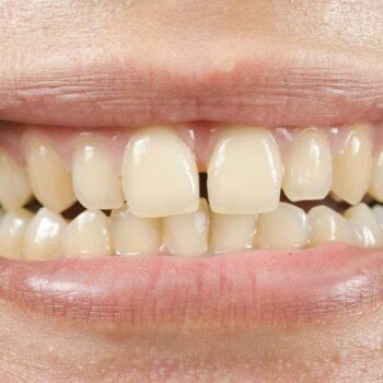 yellow teeth-232bb9e4