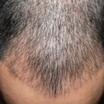 Hair Transplant